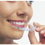 Invisalign braces