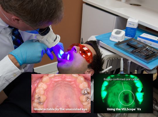 An actual example of oral cancer being detected using a VELscope device